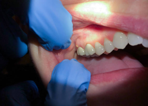 Best Knocked-Out Tooth Emergency  in Deerfield, MI